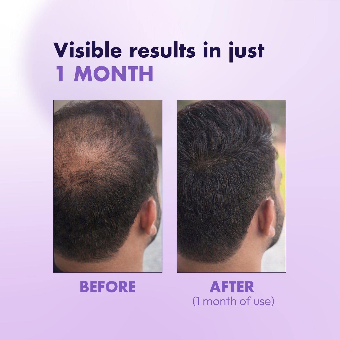 Advanced Hair Growth Serum for Thicker, Stronger Hair | Controls Hair Loss & Breakage | With Redensyl, Caffeine & Anagain | 30 ml